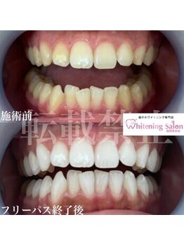 ホワイトニングサロン 福岡博多店/ホワイトニング
