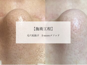 ラトワ(LATOWA)/毛穴改善 S-more