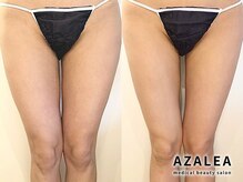 アザレア(Azalea)/スタンプ&サーマリフトで美脚に