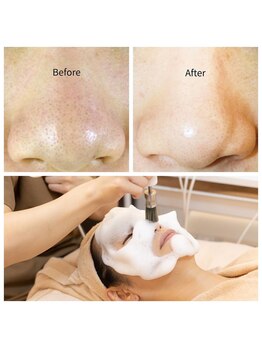 サロンドフルール/【毛穴改善】毛穴洗浄