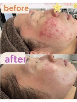 ニキビケア研究所 所沢店/どこに行っても改善しない肌も!