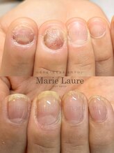 マリーロール 淀屋橋本店(Marie Laure)/自爪育成/深爪矯正/ネイルケア