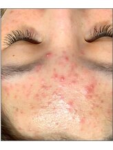 リベル 名古屋(Lebelle:)/ハーブピーリング専門名古屋