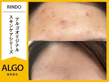 アルゴ 小松店(ALGO)/エステ×脱毛（20代前半）