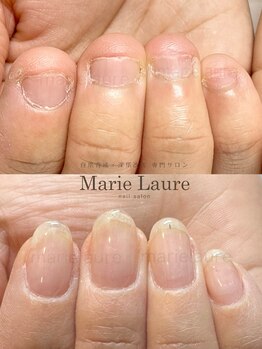 マリーロール 梅田店(Marie Laure)/深爪矯正/自爪育成/ネイルケア