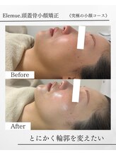 エレミュー 烏丸(Elemue.)/顎下もたつきゼロ