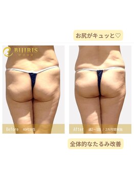 キングスサロン 熊本/お尻のたるみの変化！