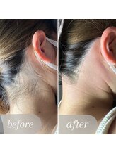 エピナス 大和店/before→after【うなじ脱毛】