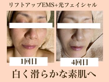 ラーナ(Lana)/リフトアップEMS×光　