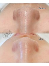 ルミナエステ(LUMINA ESTH)/毛穴/毛穴洗浄/毛穴ケア｜症例