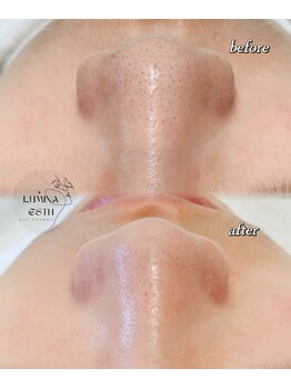 ルミナエステ(LUMINA ESTH)/毛穴/毛穴洗浄/毛穴ケア|症例