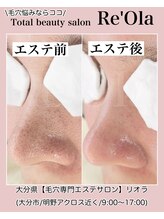 ニュートラル(neutral)/毛穴エクストラクションプロ大分