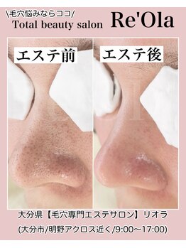 ニュートラル(neutral)/毛穴エクストラクションプロ大分