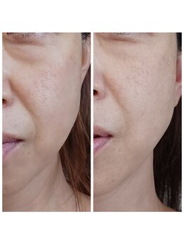 越前屋/1回のエステで