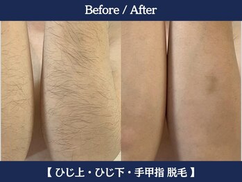 ランドマーク 中崎町(LANDMARK.)/《 腕 》