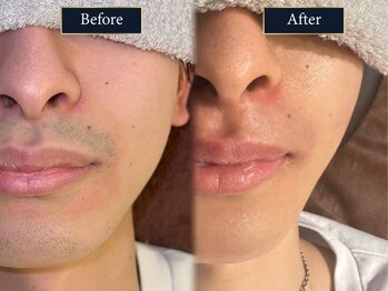 グラスト(Grast)/ヒゲ脱毛|福岡/大橋/天神/博多