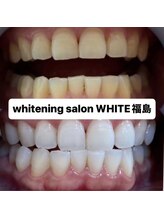 ホワイトニングサロン ホワイト(WHITE)/セルフホワイトニング効果