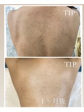 シャルム(charme)/背中ニキビ,シミケア！