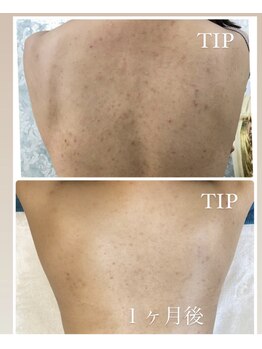 シャルム(charme)/背中ニキビ,シミケア!