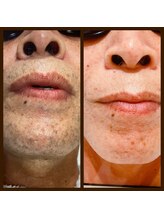 リアンジュ/ヒゲ脱毛の経過