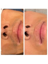 ラディエンス 多治見店/メンズひげ脱毛