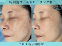 リメイククリニカルビューティー(Remake clinical beauty)/しみとり通いやめました！