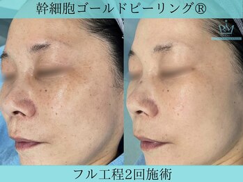 リメイククリニカルビューティー(Remake clinical beauty)/しみとり通いやめました!