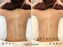 ホクビューティー(HOCU BEAUTY)/背中のハーブピーリング♪【5g】