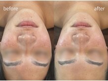 ヒミー(himee)/首肩凝り改善●小顔ウィンバック