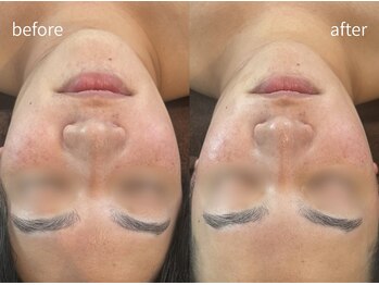 ヒミー(himee)/首肩凝り改善●小顔ウィンバック