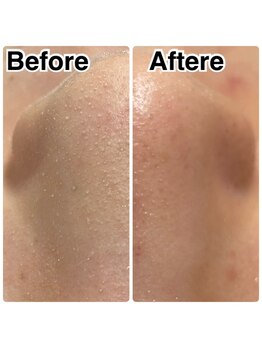 オルズ(Olu's)/ハーブピーリング｜毛穴洗浄