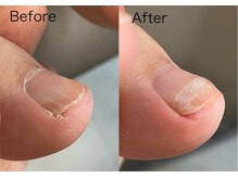 ロンディネ(Rondine)/巻き爪ケア&ネイルトリム08241