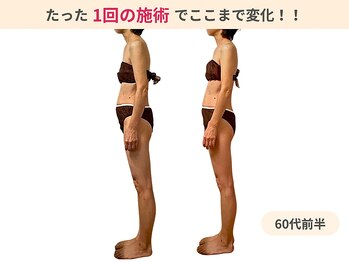 ラルーエ 仙台/ぽっこりお腹も一度でスッキリ!