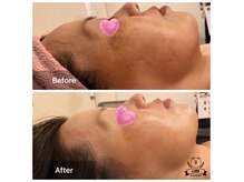 50代女性しみ、しわ対策レチノールコース人気メニュー