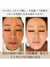 明日の“可愛い”は前日に仕込む★水光ハイドラFacial《毛穴ケア・艶肌作り》