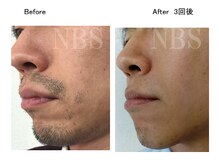 ラディアアンドココサロン(Radia&Coco_salon)/ヒゲ脱毛ビフォーアフター☆