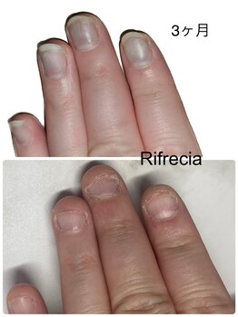 リフレシア(Rifrecia)/3ヶ月で爪が伸びた！
