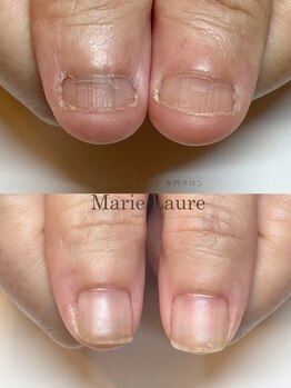マリーロール 梅田店(Marie Laure)/自爪育成/深爪矯正/ネイルケア