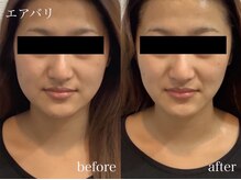 エムドット(M.)/エアバリの効果に驚く方続出★