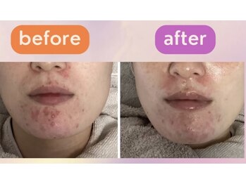 ニキビケア研究所 所沢店/10年間の悩みも1ヶ月でここまで