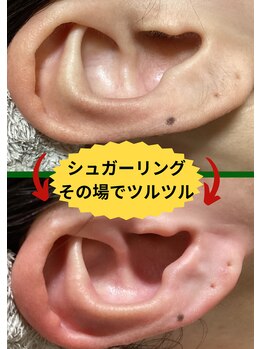 ディスイズミー シュガーリング(This is me Sugaring)/【シュガー】ここも脱毛出来る