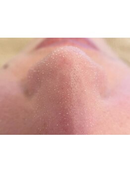 毛穴ケアをしたい