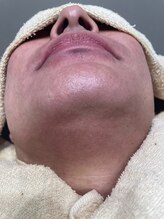 アムール(Amour)/メンズ脱毛12回目月一回5分だけ