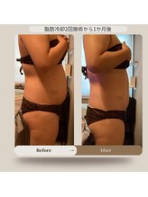 トータルサロン ヴィータ(VITA.)/痩身/脂肪冷却♪