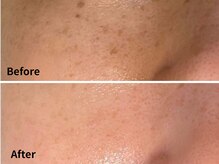 ルーチェ(LUCE)/光フェイシャルBefore→After
