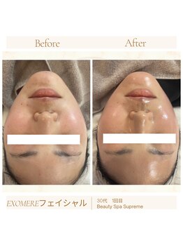 シュプレーム(Supreme)/エクソミアフェイシャル/毛穴無