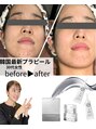 サロンスペース 新浦安店 毛穴/ニキビ改善/毛穴/ハーブピーリング/シミケア/美白/新浦安