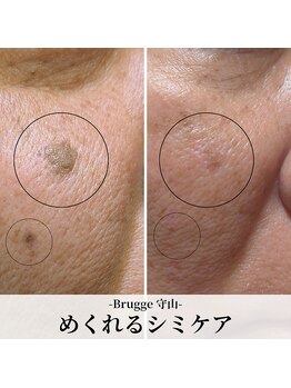 ブルージュ(Brugge)の写真/滋賀 守山で「めくれるシミケア」誕生★気になるシミをピンポイント施術！色戻り予防サポート付きです