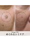 ブルージュ(Brugge)の写真/滋賀 守山で「めくれるシミケア」誕生★気になるシミをピンポイント施術！色戻り予防サポート付きです