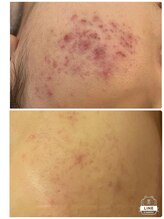 エステサロン クブ(Kubu)/ハーブピーリング×光トーニング